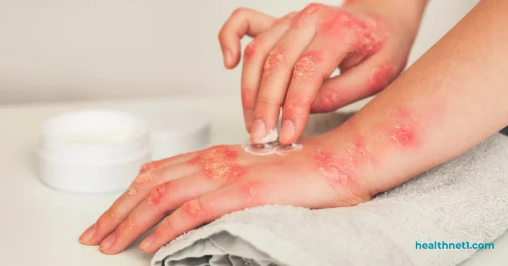 natural remedies for fungal skin infections