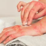 natural remedies for fungal skin infections